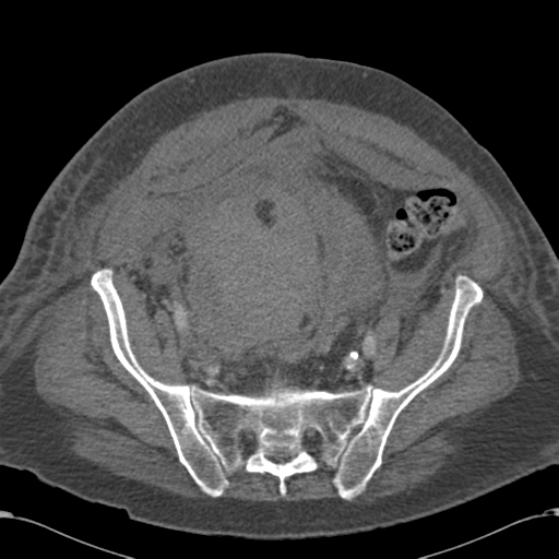 Abdominal hematoma (Radiopaedia 33614-34715 Axial C+ portal venous phase 99).png
