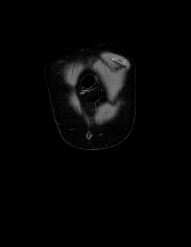 Abdominal lymphoma - with sandwich sign (Radiopaedia 53486-59492 C+ portal venous phase 58).jpg