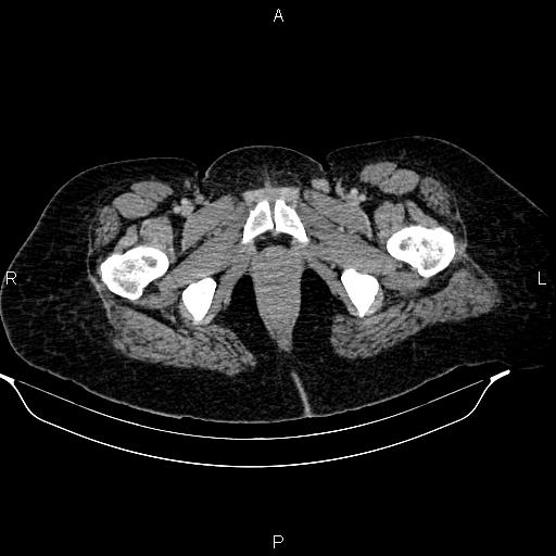 Abdominal lymphoma with sandwich sign (Radiopaedia 84378-99704 Axial C+ portal venous phase 60).jpg