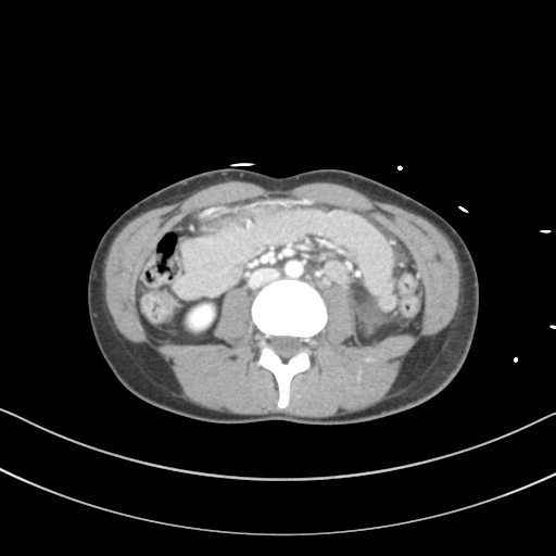 File:Abdominal multi-trauma - devascularised kidney and liver, spleen and pancreatic lacerations (Radiopaedia 34984-36486 Axial C+ portal venous phase 43).png
