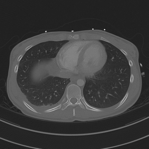 File:Abdominal multi-trauma - devascularised kidney and liver, spleen and pancreatic lacerations (Radiopaedia 34984-36486 I 63).png