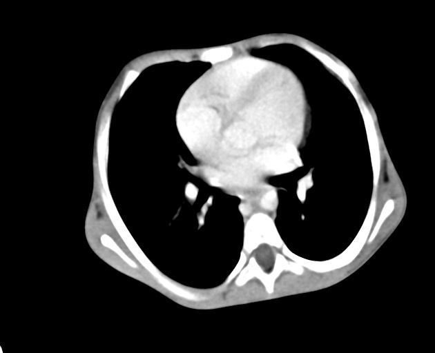 Abdominopelvic rhabdomyosarcoma (Radiopaedia 78356-90984 Axial C+ portal venous phase 23).jpg