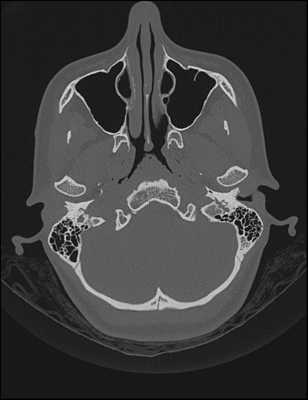 Aberrant right internal carotid artery (Radiopaedia 65191-74198 Axial non-contrast 23).jpg