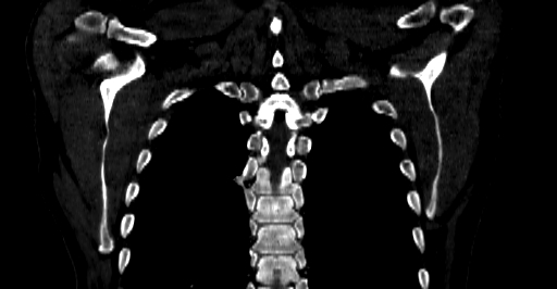 File:Accesory rib joint (Radiopaedia 71987-82452 Coronal bone window 54).jpg