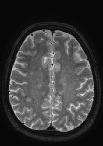File:Accessory middle cerebral artery (Radiopaedia 73114-83828 Axial T2 1).jpg
