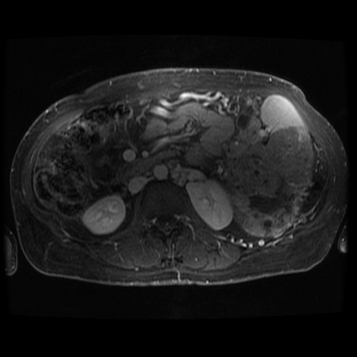 Acinar cell carcinoma of the pancreas (Radiopaedia 75442-86668 Axial T1 C+ fat sat 33).jpg