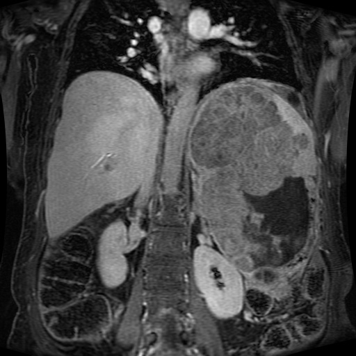 Acinar cell carcinoma of the pancreas (Radiopaedia 75442-86668 Coronal T1 C+ fat sat 81).jpg