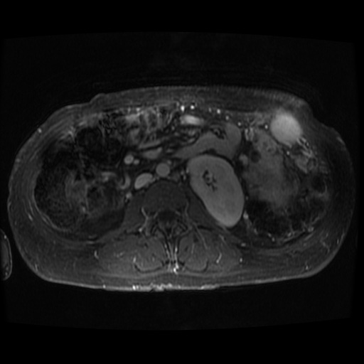 Acinar cell carcinoma of the pancreas (Radiopaedia 75442-86668 D 13).jpg