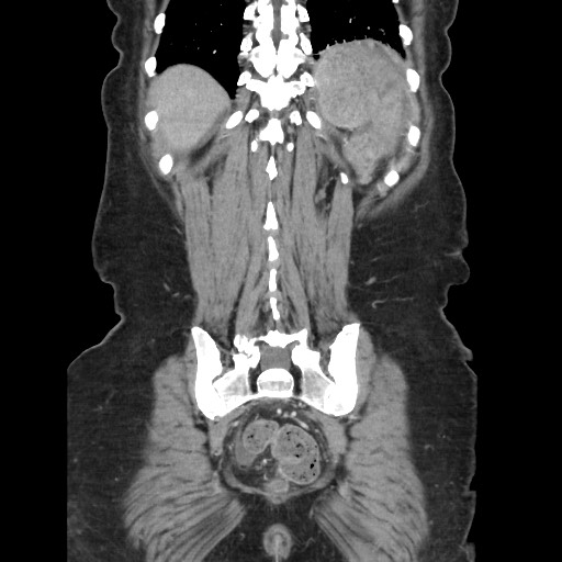 Acinar cell carcinoma of the pancreas (Radiopaedia 75442-86669 Coronal C+ portal venous phase 105).jpg