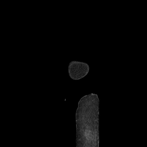 Acinar cell carcinoma of the pancreas (Radiopaedia 75442-86669 Sagittal C+ portal venous phase 11).jpg