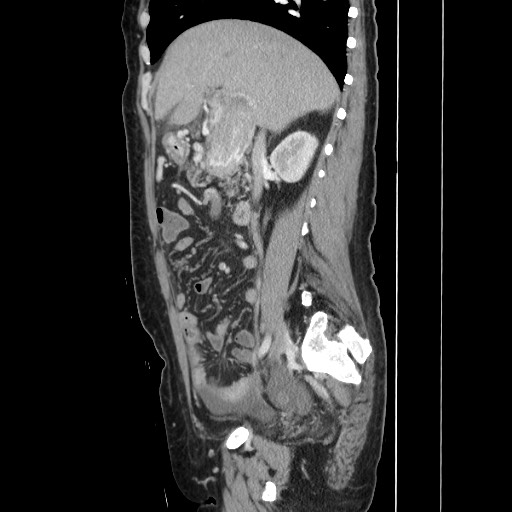 File:Acinar cell carcinoma of the pancreas (Radiopaedia 75442-86669 Sagittal C+ portal venous phase 77).jpg