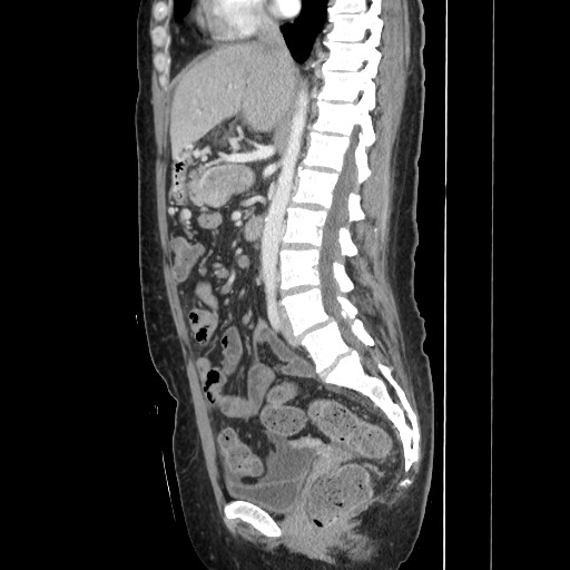 Acinar cell carcinoma of the pancreas (Radiopaedia 75442-86669 Sagittal C+ portal venous phase 94).jpg