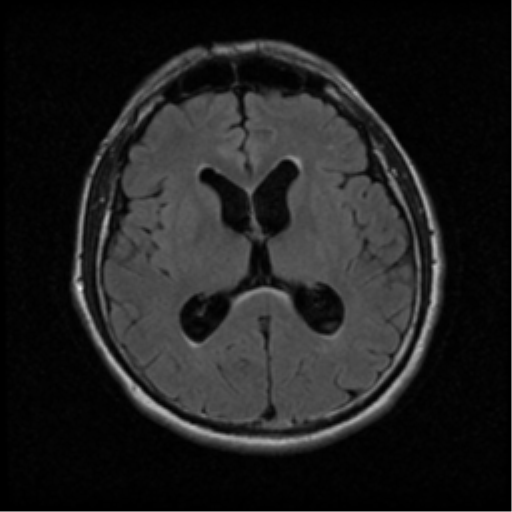File:Acoustic schwannoma (Radiopaedia 39170-41387 Axial FLAIR 12).png