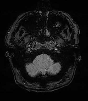 Acoustic schwannoma (Radiopaedia 50846-56358 Axial SWI 10).png