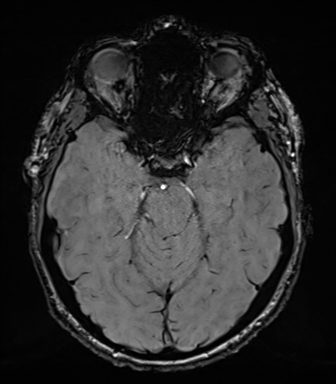 Acoustic schwannoma (Radiopaedia 50846-56358 Axial SWI 34).png