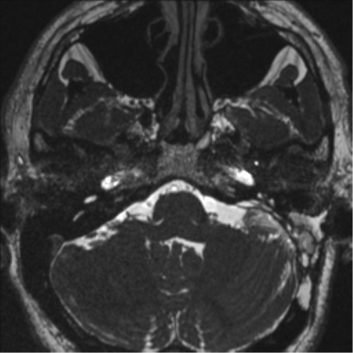Acoustic schwannoma (translabyrinthine resection) (Radiopaedia 43570-46972 Axial CISS 21).png