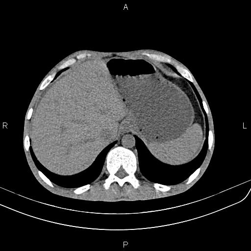 File:Active crohn disease (Radiopaedia 87133-103397 Axial non-contrast 16).jpg