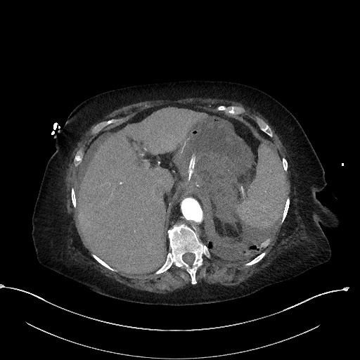 Active renal extravasation with large subcapsular and retroperitoneal hemorrhage (Radiopaedia 60975-68796 Axial C+ arterial phase 42).jpg