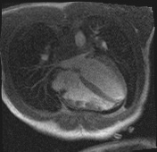 Active right ventricular cardiac sarcoidosis (Radiopaedia 55596-62100 Axial Dynamic perfusion scan MOCO 97).jpg