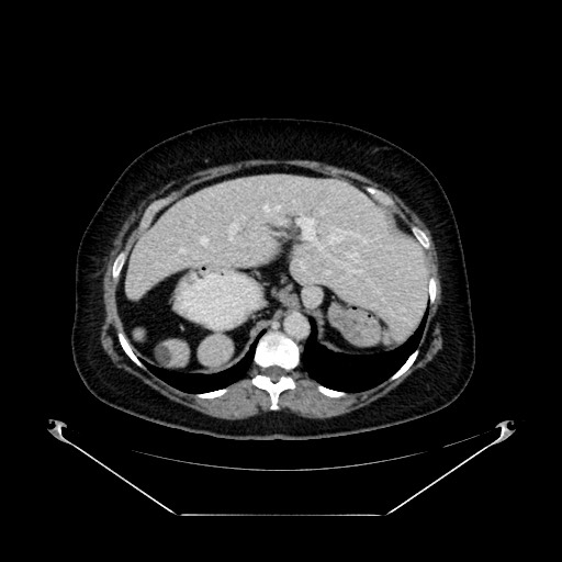 Acute appendicitis, heterotaxy syndrome (Radiopaedia 66884-76202 Axial C+ portal venous phase 30).jpg
