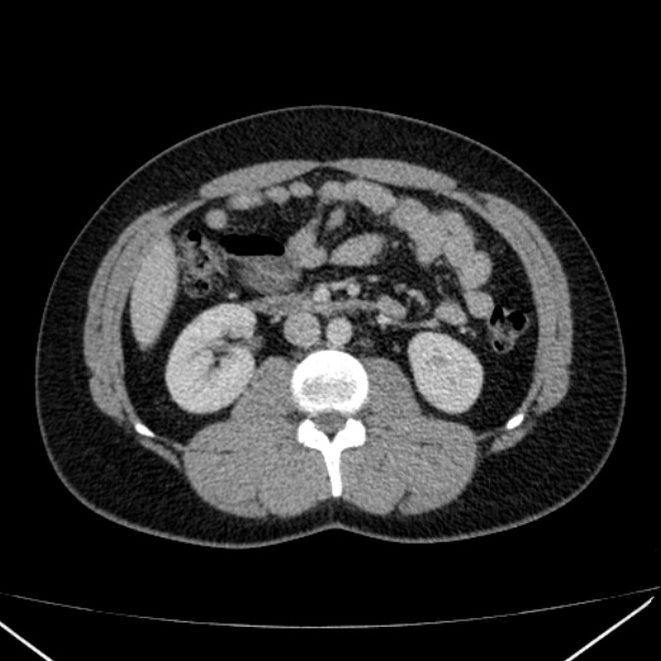 Acute appendicitis (Radiopaedia 38255-40270 Axial C+ portal venous phase 47).jpg