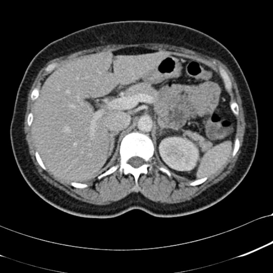 Acute appendicitis (Radiopaedia 48792-53822 Axial C+ portal venous phase 31).jpg