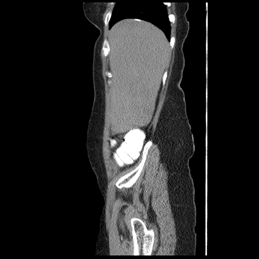 File:Acute appendicitis (Radiopaedia 52672-58589 Sagittal C+ arterial phase 11).jpg