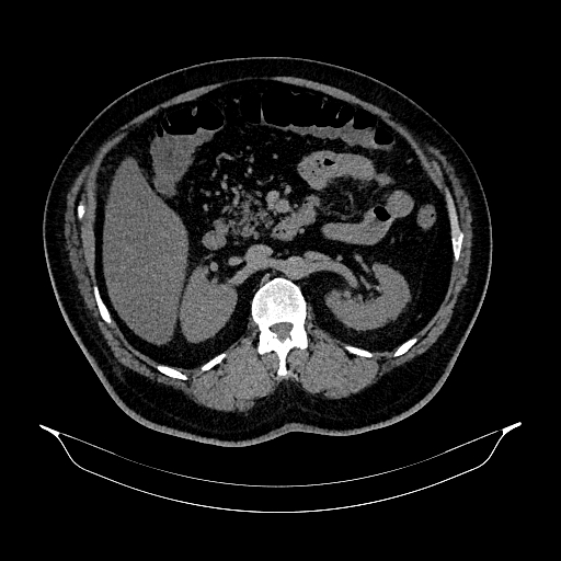File:Acute appendicitis (Radiopaedia 79950-93224 Axial non-contrast 40).jpg