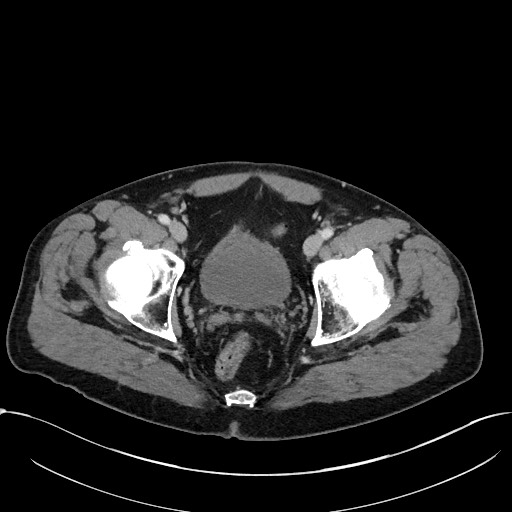 Acute appendicitis - large appendicoliths (Radiopaedia 61805-69820 Axial C+ portal venous phase 119).jpg