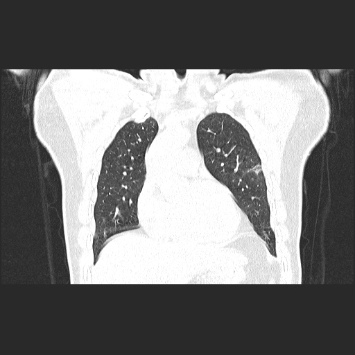 Acute appendicitis and COVID 19 pneumonia (Radiopaedia 76604-88380 G 22).jpg
