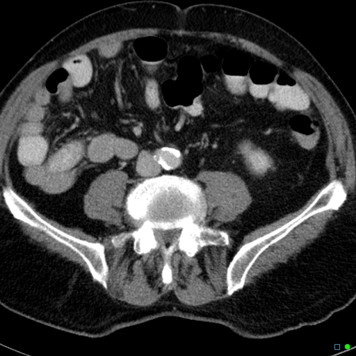 File:Acute appendicitis arising from a malrotated cecum (Radiopaedia 19970-19997 Axial C+ portal venous phase 23).jpg