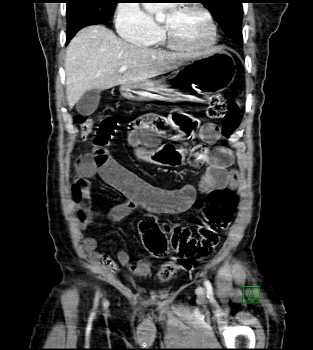 Acute arterial mesenteric ischemia (Radiopaedia 78238-90828 Coronal C+ portal venous phase 35).jpg