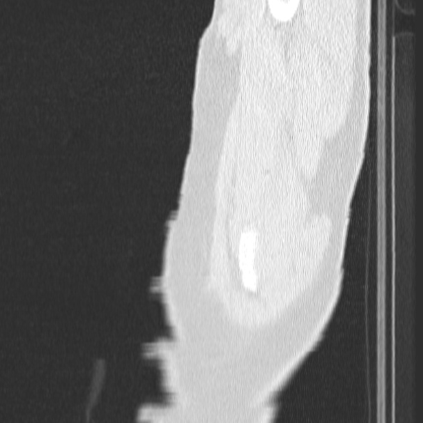 Acute aspiration pneumonitis (Radiopaedia 33605-34703 Sagittal lung window 1).jpg