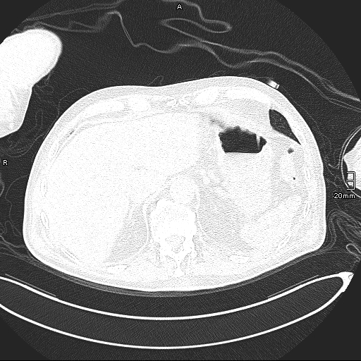 Acute aspiration pneumonitis (Radiopaedia 55642-62166 Axial lung window 141).jpg