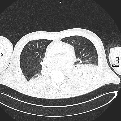 Acute aspiration pneumonitis (Radiopaedia 55642-62166 Axial lung window 84).jpg
