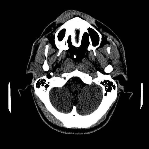 Acute basilar artery occlusion (Radiopaedia 43582-46985 Axial non-contrast 36).jpg