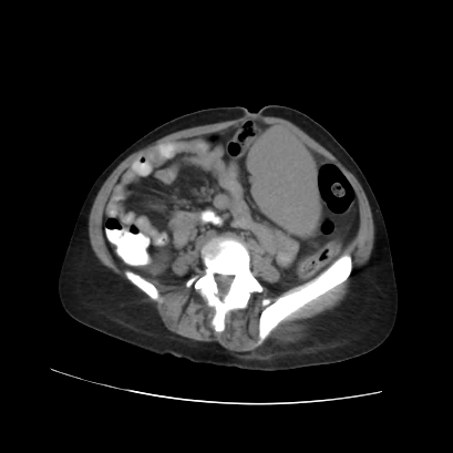 File:Acute calculous cholecystitis in patient with osteopetrosis (Radiopaedia 77871-90159 Axial non-contrast 54).jpg