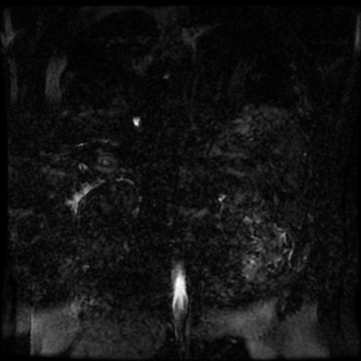 Acute cholecystitis and biliary hamartomas (Radiopaedia 86231-102240 E 4).jpg