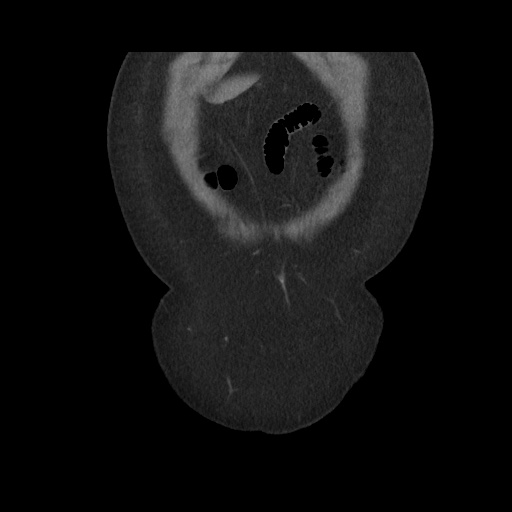 File:Acute cholecystitis with tensile fundus sign (Radiopaedia 71394-81723 Coronal non-contrast 23).jpg