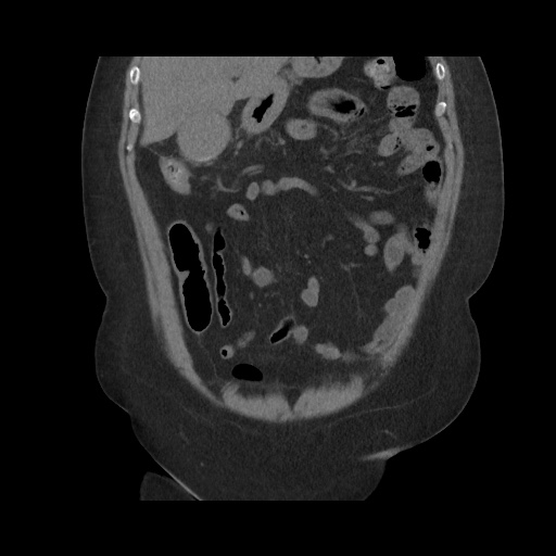 File:Acute cholecystitis with tensile fundus sign (Radiopaedia 71394-81723 Coronal non-contrast 46).jpg