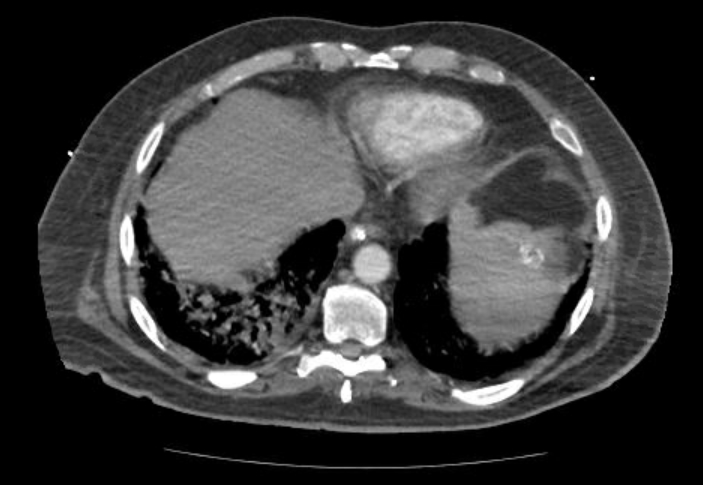 File:Acute cor pulmonale (ultrasound) (Radiopaedia 83508-98818 Axial 131).jpg