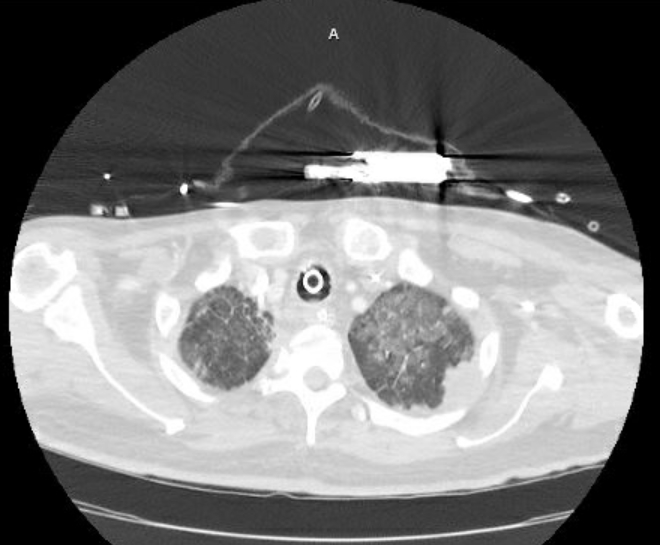 Acute cor pulmonale (ultrasound) (Radiopaedia 83508-98818 Axial lung window 16).jpg