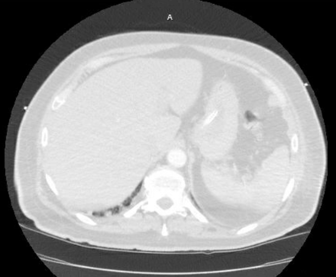 Acute cor pulmonale (ultrasound) (Radiopaedia 83508-98818 Axial lung window 87).jpg