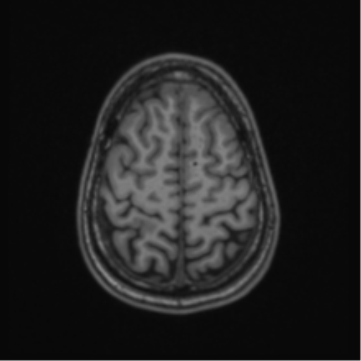 Acute disseminated encephalomyelitis (ADEM) (Radiopaedia 65319-74349 Axial T1 57).png