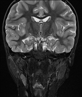 File:Acute disseminating encephalomyelitis with bilateral optic neuritis (Radiopaedia 79676-92886 Coronal STIR 20).jpg