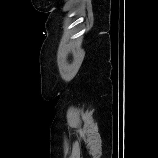 Acute diverticulitis - transverse colon (Radiopaedia 87063-103327 Sagittal C+ portal venous phase 45).jpg