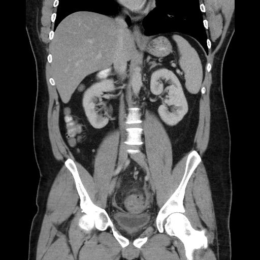 Acute diverticulitis with localized perforation (Radiopaedia 41296-44113 Coronal C+ portal venous phase 36).jpg