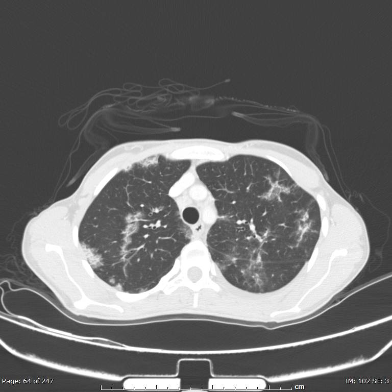 Acute eosinophilic pneumonia (Radiopaedia 48211-53073 Axial lung window 23).jpg