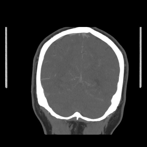 Acute internal carotid artery dissection (Radiopaedia 53541-59630 E 65).jpg