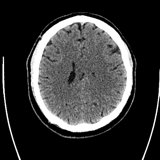 Acute left middle cerebral artery territory ischemic stroke (Radiopaedia 35688-37223 Axial non-contrast 54).png